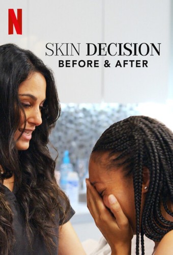 skin decision before and after